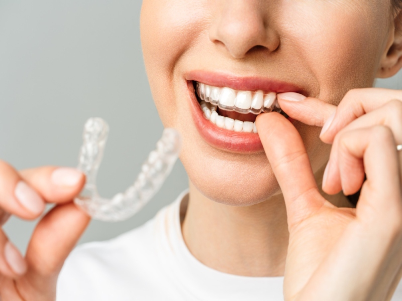 יישור שיניים – אילו טכנולוגיות חדשות קיימות וכיצד הן משפרות את תהליך הטיפול 