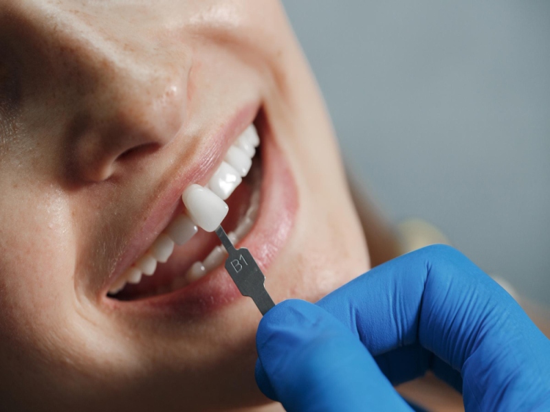ציפויי שיניים -  כיצד הם משפרים את מראה השיניים שלנו