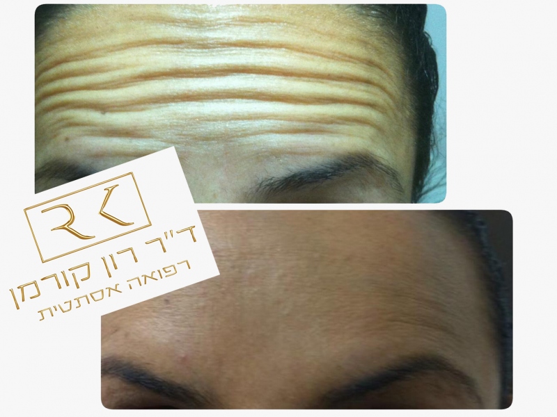 טיפול מוצלח ברפואה אסתטית - מרכיבי הטיפול