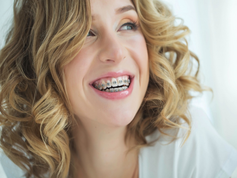 למה חשוב לשים יישור שיניים?