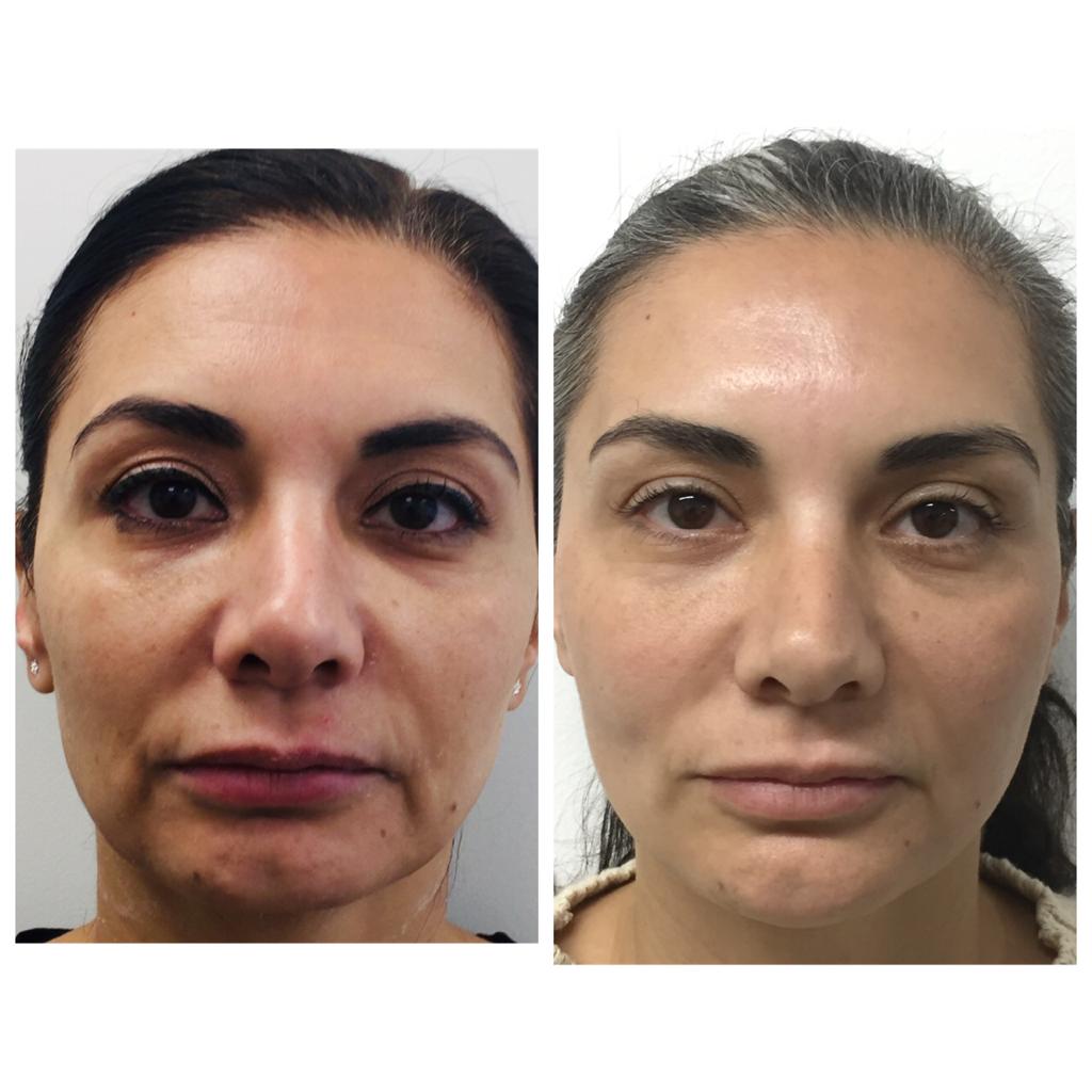 טיפול בבוטוקס