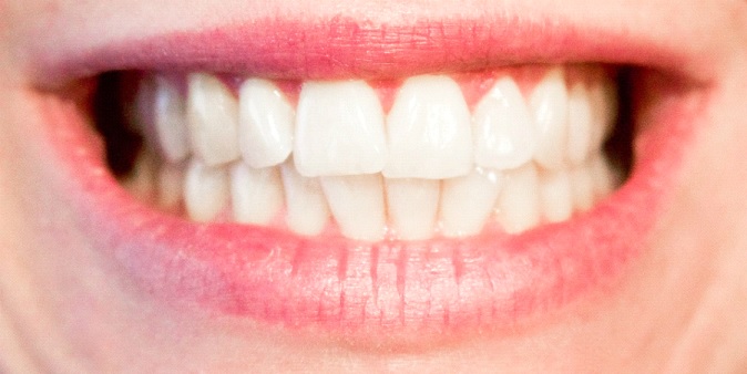 שתלים ביום אחד