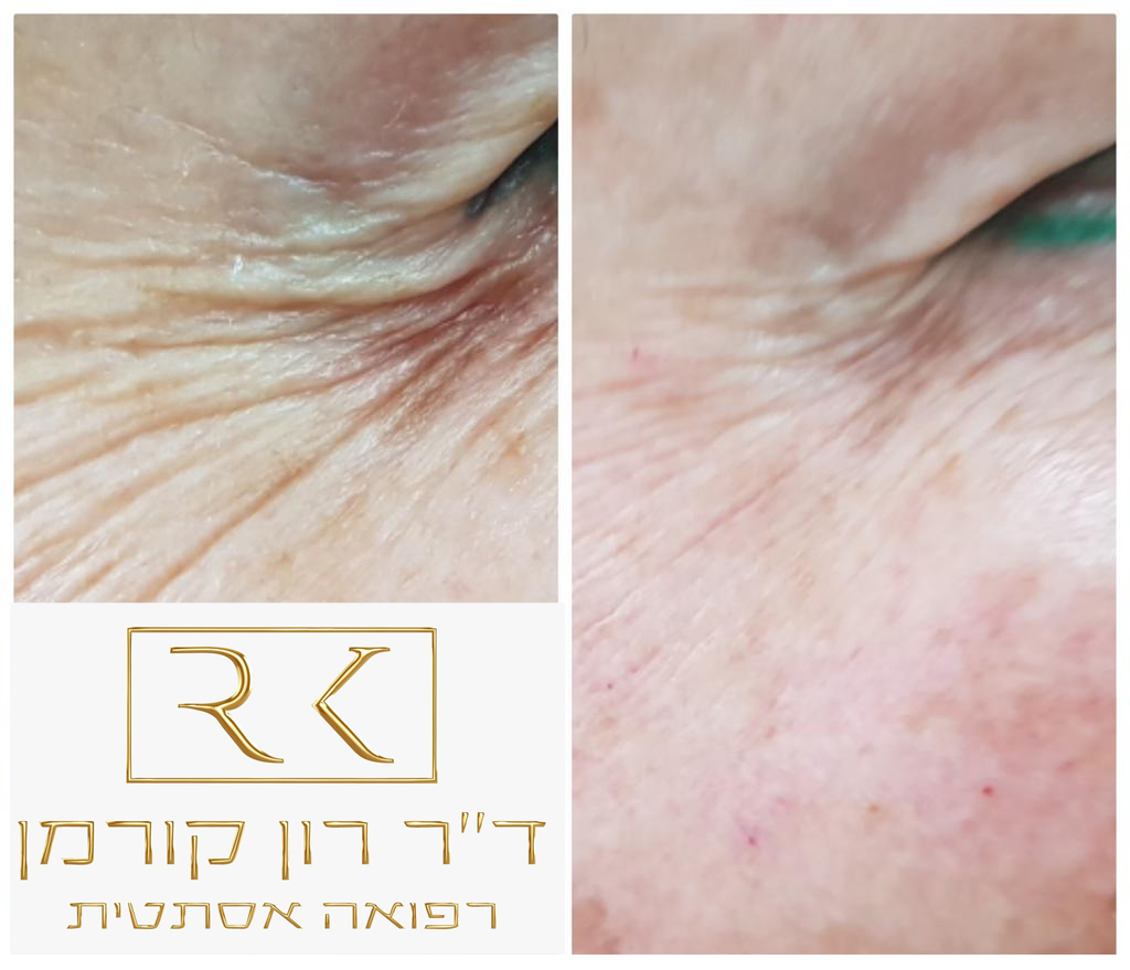 טיפול מוצלח ברפואה אסתטית