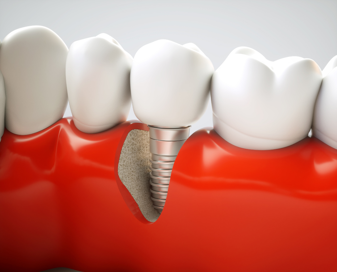 השתלות שיניים במרכז רפואי גרה קליניק
